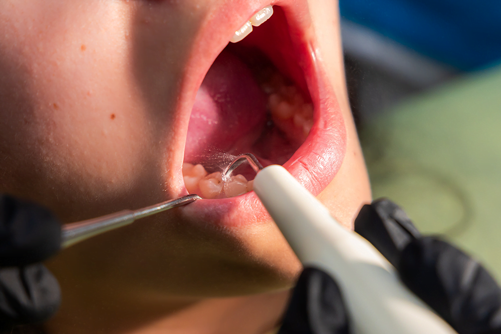 dental-texture-profilaxie-dentara-airflow