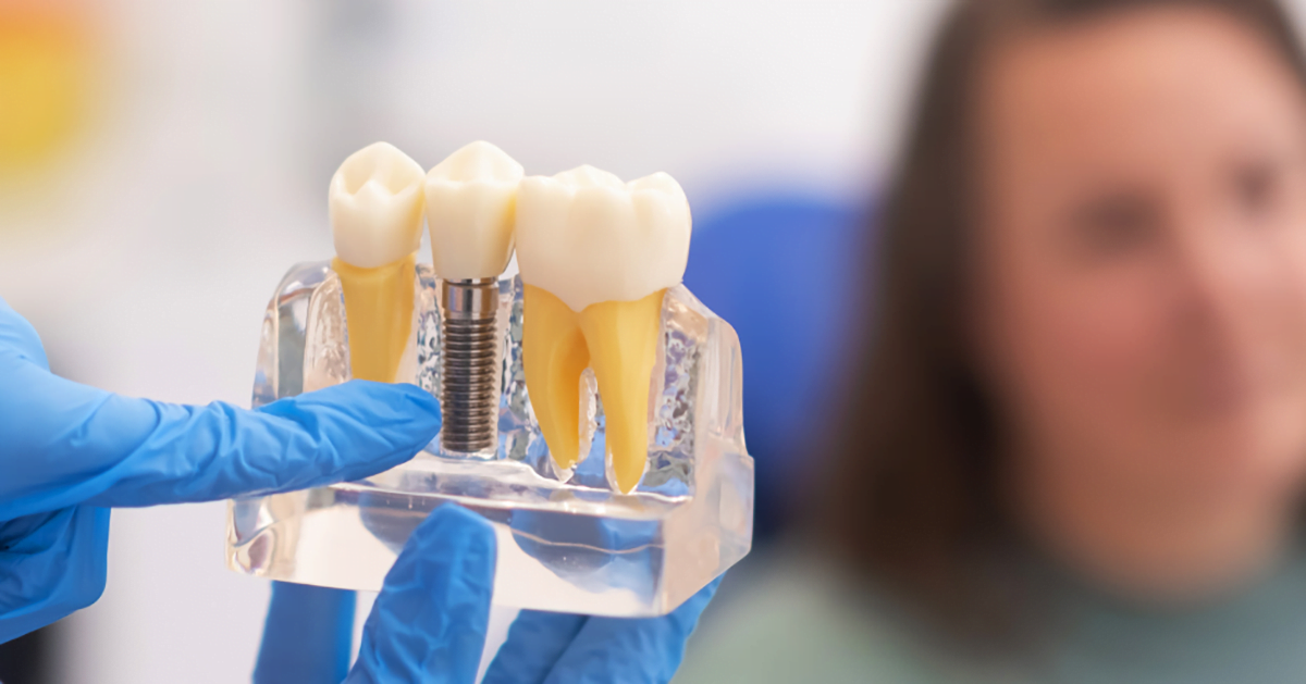 Modalitati de inlocuire a dintilor lipsa